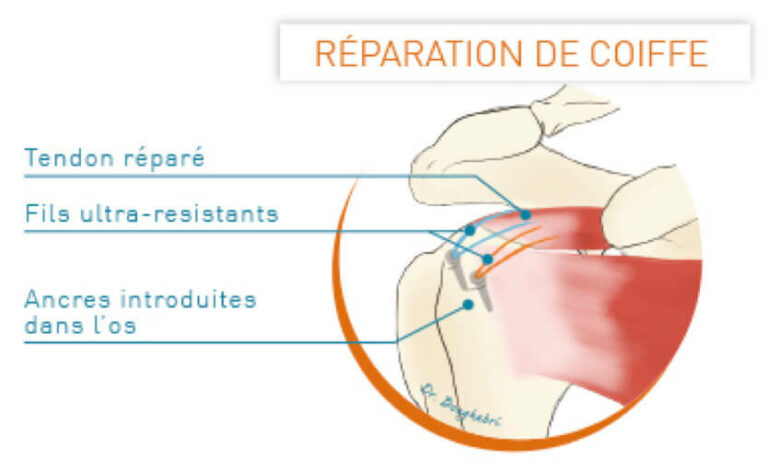 Rupture De Coiffe Des Rotateurs Diagnostic – RZAWS
